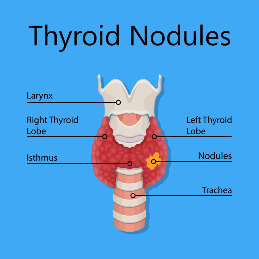 Graphic of thyroid nodule radiofrequency ablation for benign nodules